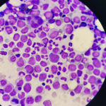 Blood Cancer Therapies